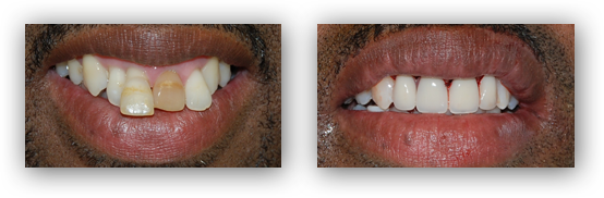 Dental Implants