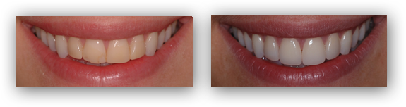 Porcelain Veneers