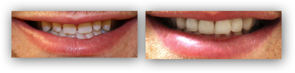 All Porcelain Crowns