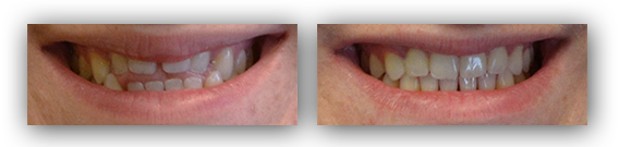 Invisalign Orthodontics with Composite Bonding