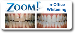 In Office Whitening